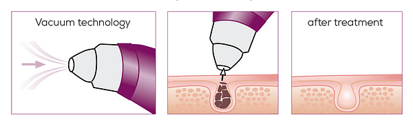 работа очистителя пор